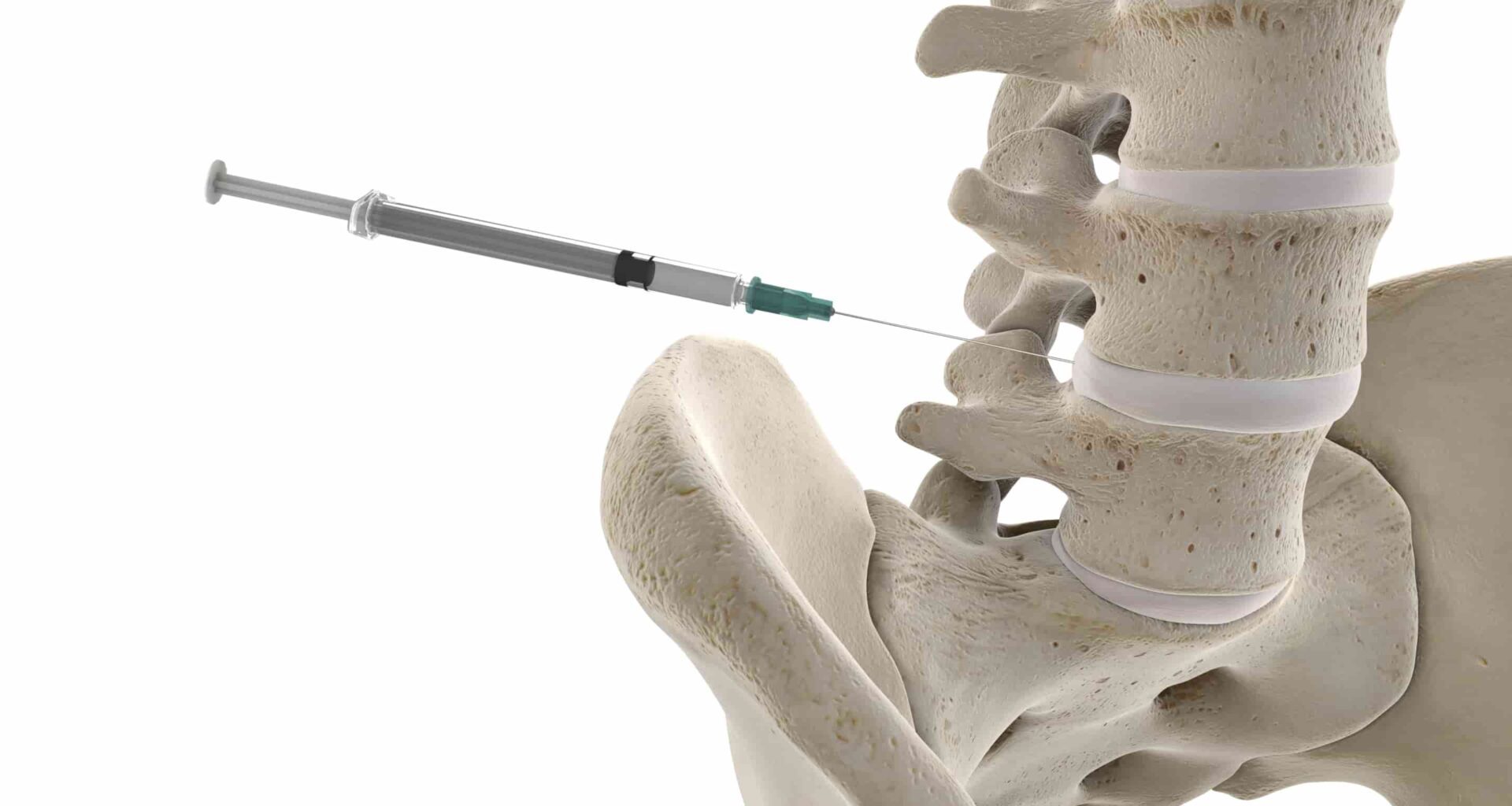 infiltracao-foraminal-itc-vertebral-1-1920x1024
